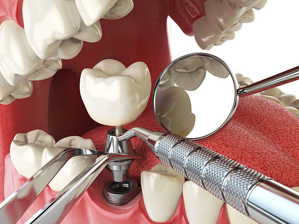 Best Dentist for Tooth Abscess  in Half Moon Bay, CA